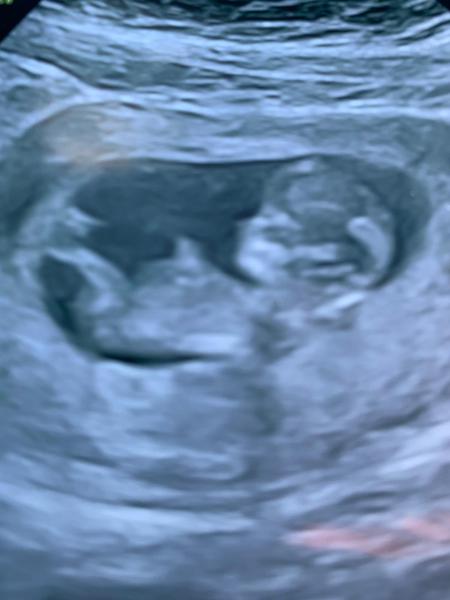 BFP! August/September 2020 Babies!