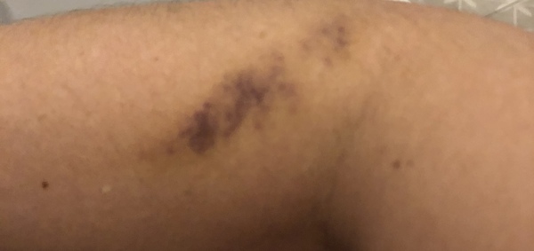 Blood taken 12 days ago, bruise still purple
