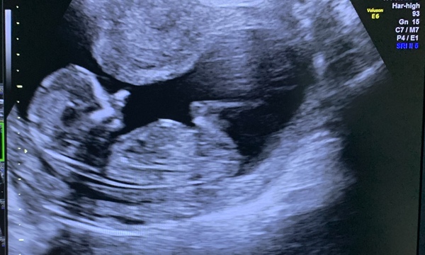 Boy or girl?