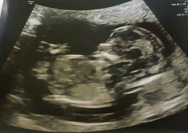 12 weeks and panicking about MMC