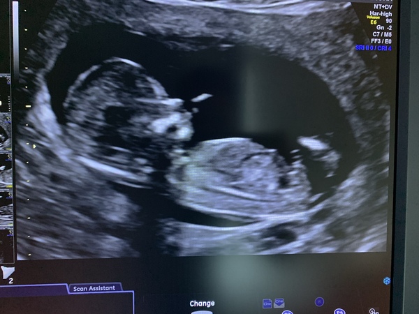 Boy or girl?