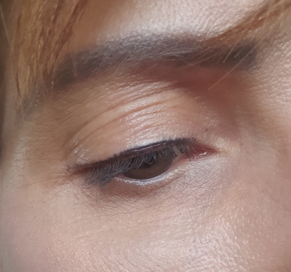 Has anyone been left with scarring after plasma pen/fibroblast?