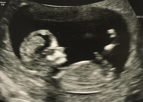 BFP! August/September 2020 Babies!