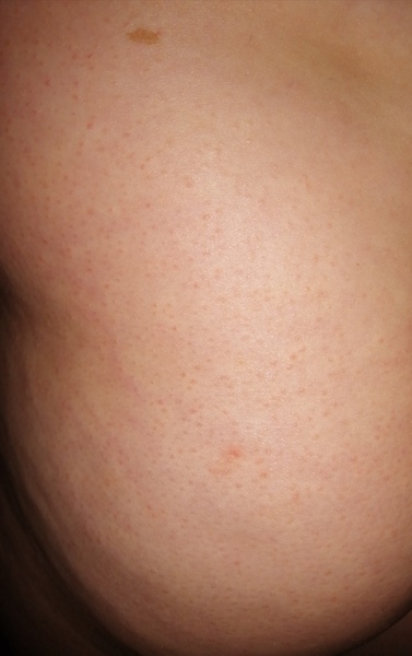 Rash