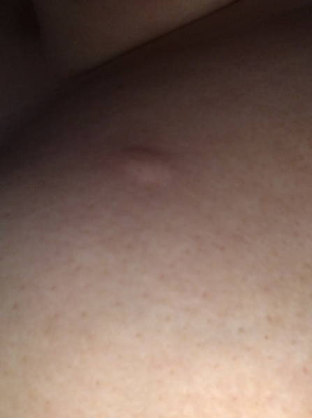 Strange lump