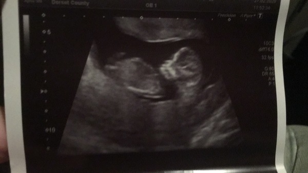Boy or girl guesses from ultrasound?