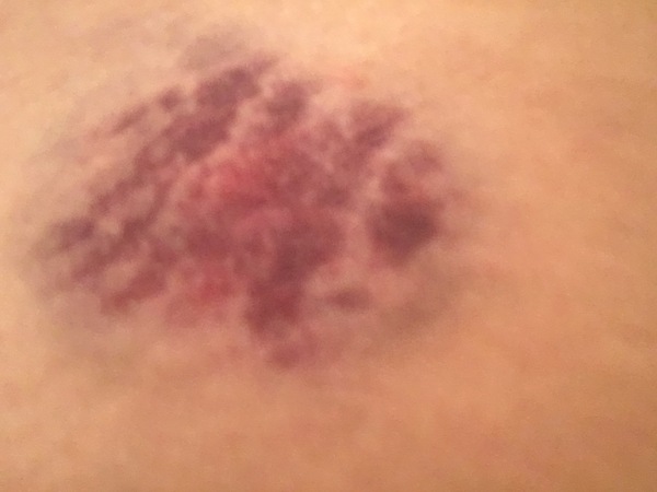 Not  strictly sporn  but bloody painful  pic included