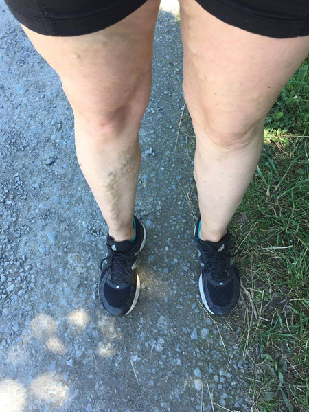 Varicose veins