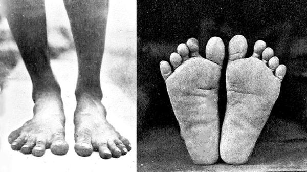 Fashion Has Deformed Women's  Feet