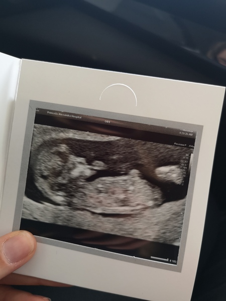 12 week scan do you think girl or boy?