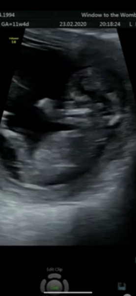 Guessing baby’s gender !