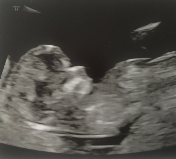 Pregnant after loss and dreaming of rainbows....