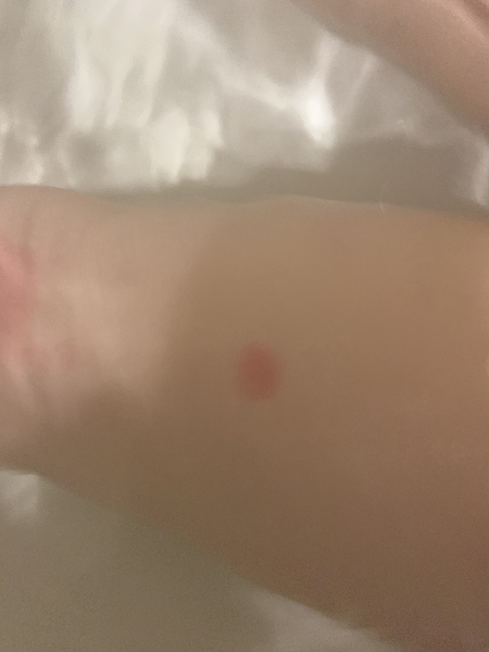 Eczema