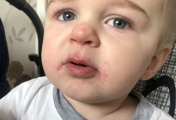 Anyone know what this rash is?