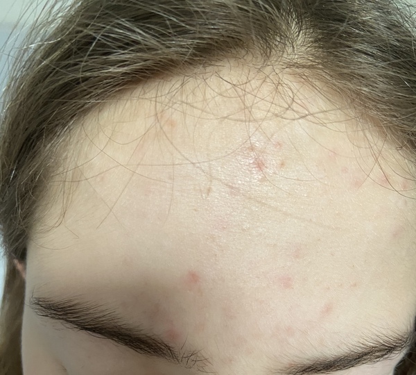 Any ideas on teen DD’s skin condition?