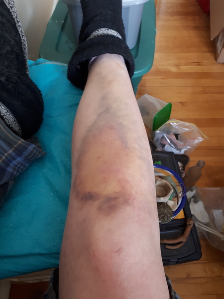 What are the most stupid injuries you’ve had?