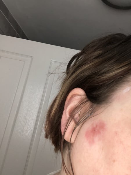 Basal Cell carcinoma - nose