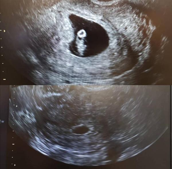Early ultrasound?