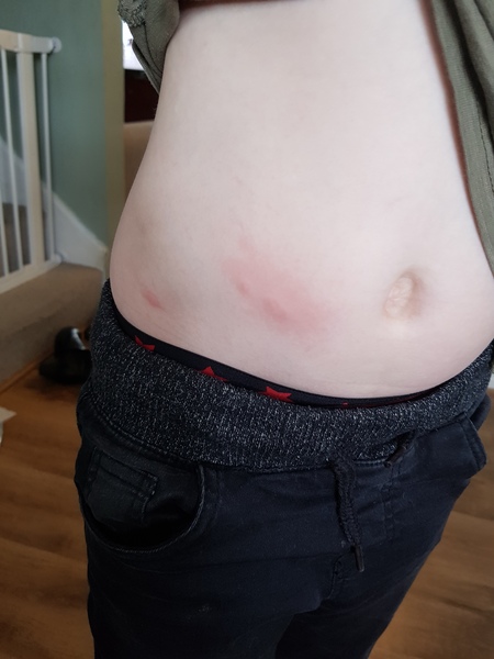 What do you think these bites could be from?