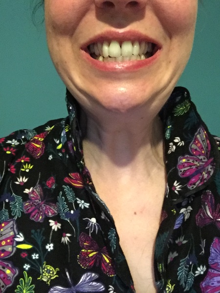 To be Depressed about my teeth do they look really bad?