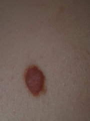 Does this look like skin cancer?