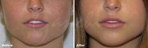 Lip fillers!