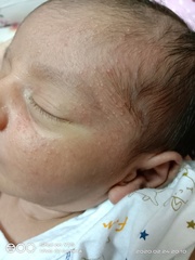 Red and white pimples over my baby's face, forehead, and head. Feeling concerned