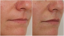 Lip fillers!