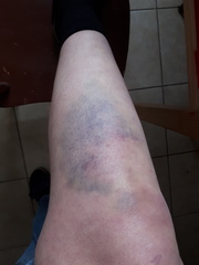 What are the most stupid injuries you’ve had?