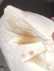 Implantation bleeding 17dpo today!