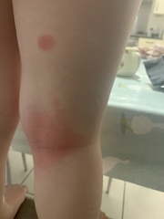 Eczema