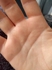 Swollen, itchy, mottled hands..