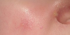 Anyone know about burns? Gross pics included