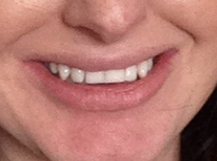 Teeth straightening?