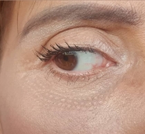 Has anyone been left with scarring after plasma pen/fibroblast?