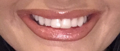 Teeth straightening?