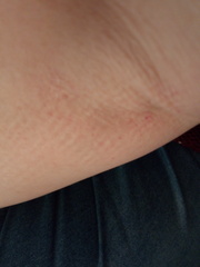 Blood spots?