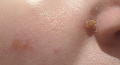 Anyone know about burns? Gross pics included