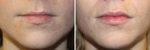 Lip fillers!