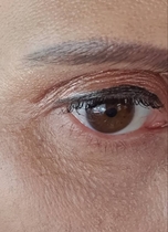 Has anyone been left with scarring after plasma pen/fibroblast?