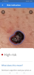 How concerned would you be about this mole?