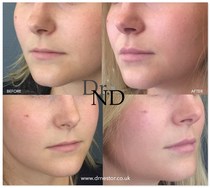 Lip fillers!