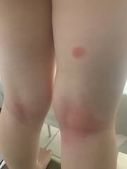 Eczema