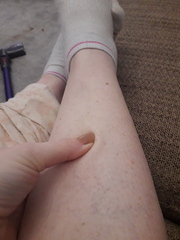 Achy legs