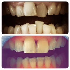 Teeth straightening?