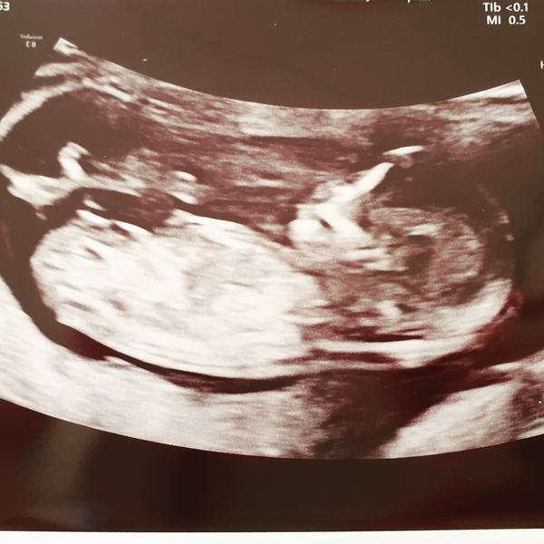 Support thread for women who are pregnant or TTC after a termination for abnormalities - Thread 6