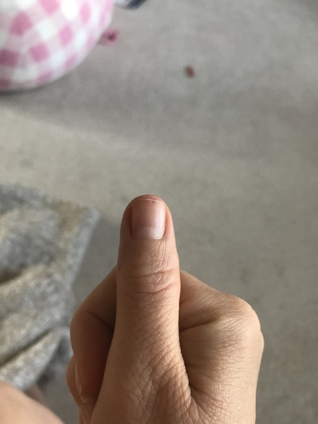 Very worried about new mark on thumb nail