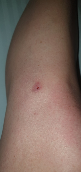 Warts and apple cider vinegar, now I have a white kneehole !