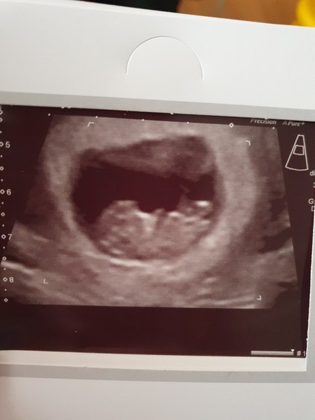 Support thread for women who are pregnant or TTC after a termination for abnormalities - Thread 5