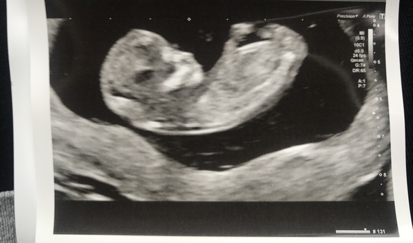 Gender guesses?! 12 week scan photo